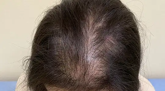 抜け毛・薄毛
