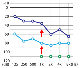 子供の突発性難聴、ムンプス難聴