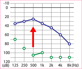 突発性難聴・メニエール病