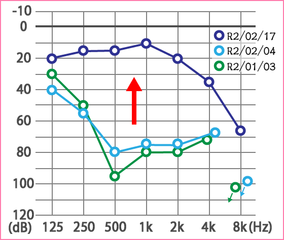 突発性難聴・メニエール病
