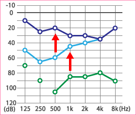 子供の突発性難聴