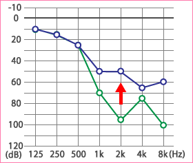 子供の突発性難聴