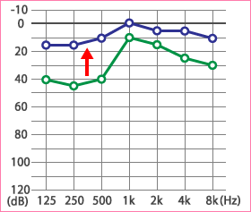 めまい・メニエール病・PPPD