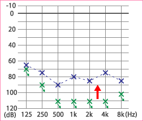 めまい・メニエール病・PPPD