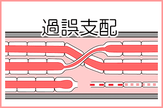 顔面神経麻痺：病的共同運動