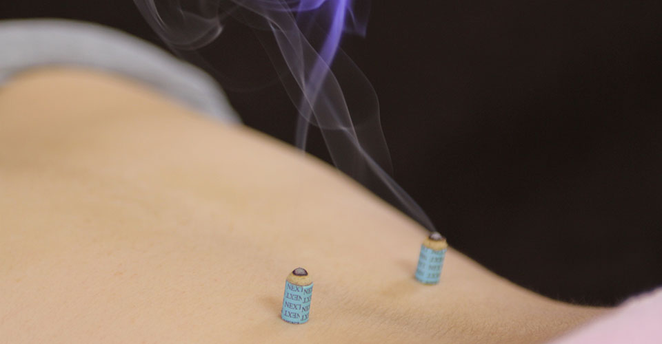 更年期障害に対する鍼灸治療