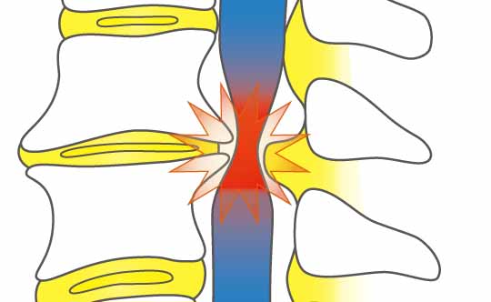 脊柱菅狭窄症の治療