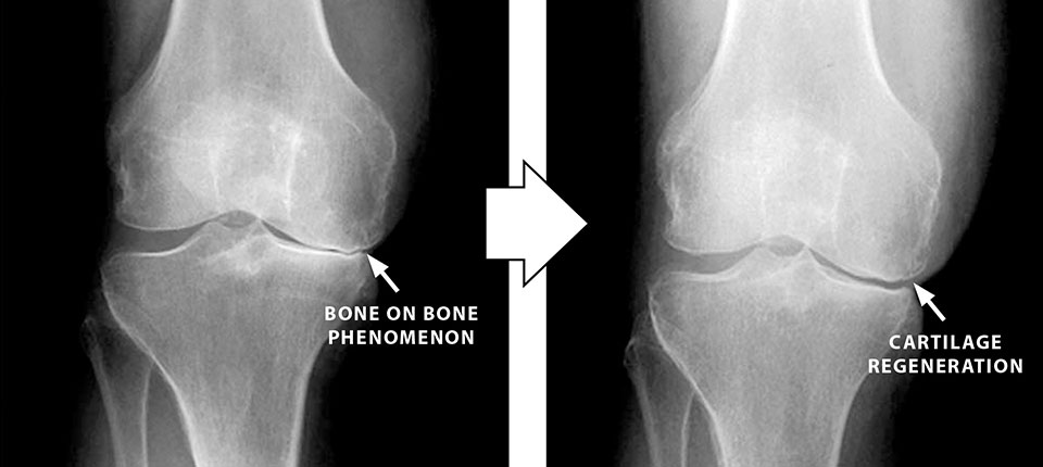 膝の痛みに再生医療