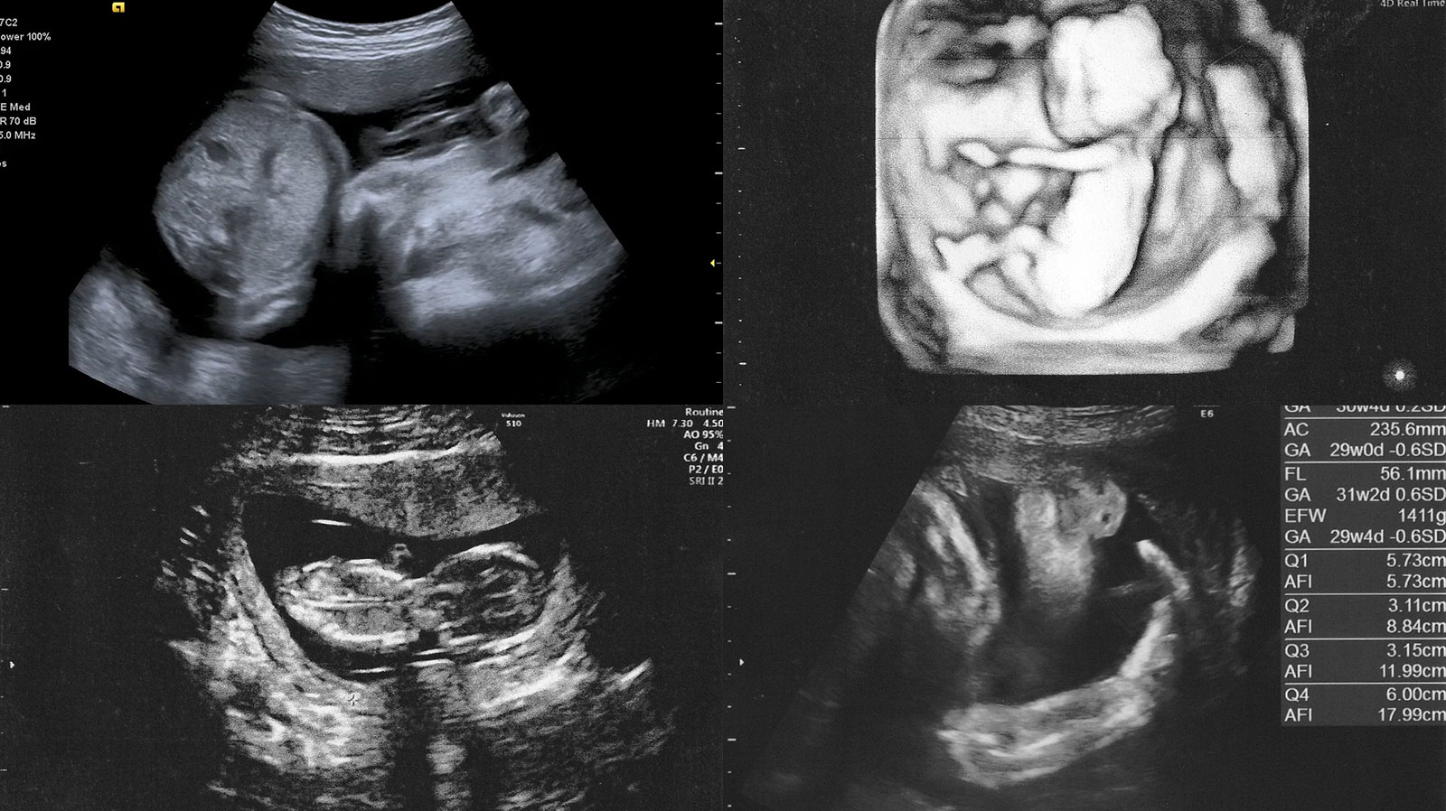 妊娠32週逆子体操で治らないときの治し方