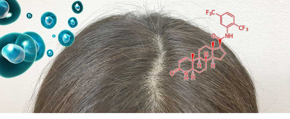 薄毛に対する鍼灸治療